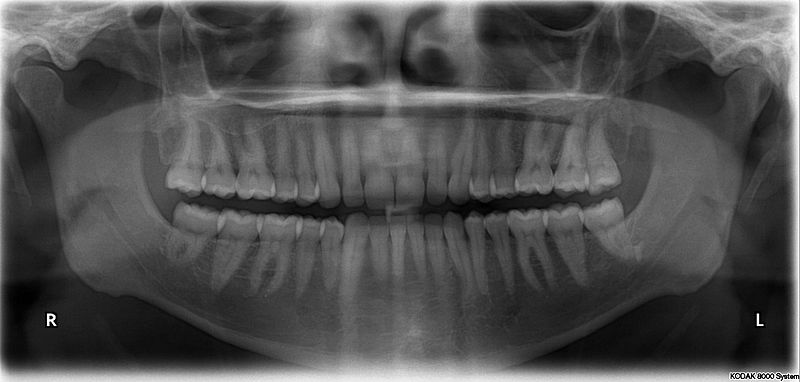 800px-X-ray_of_all_32_human_teeth.jpg