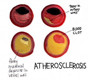 atherosclerosis