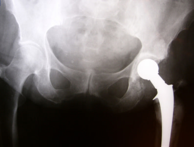 hip_replacement.jpg