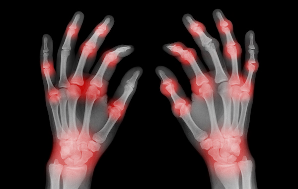 Adaptive Equipment for Arthritis in Hands and Fingers