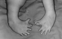 Birth defects thalidomide - Flickr