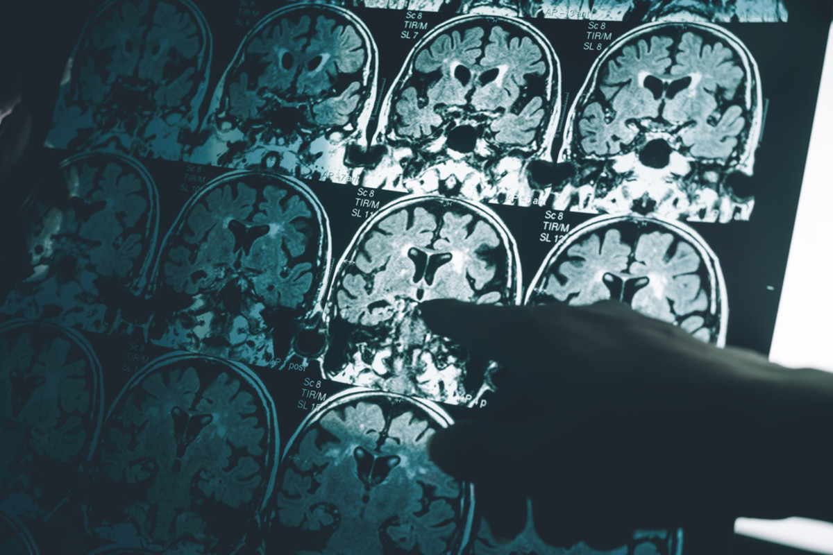 Estudo fundamental sobre Alzheimer possivelmente falsificado: 16 anos de pesquisa equivocada?
