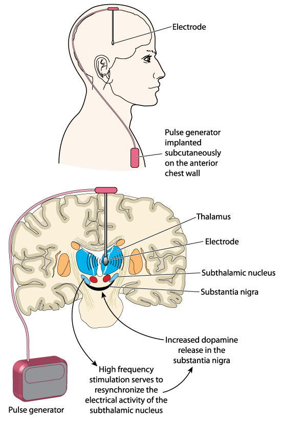 What Is Deep Brain Stimulation, And Why Does It Work For Parkinson's ...