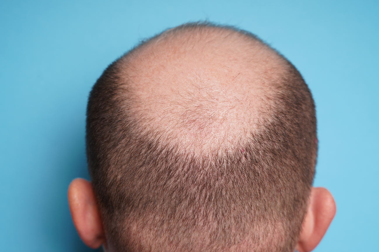 Hair Loss in Men due to Hormonal Imbalance  Healthgains