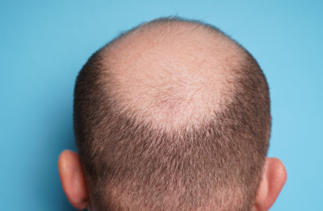 Why Do Humans Go Bald? | Discover Magazine