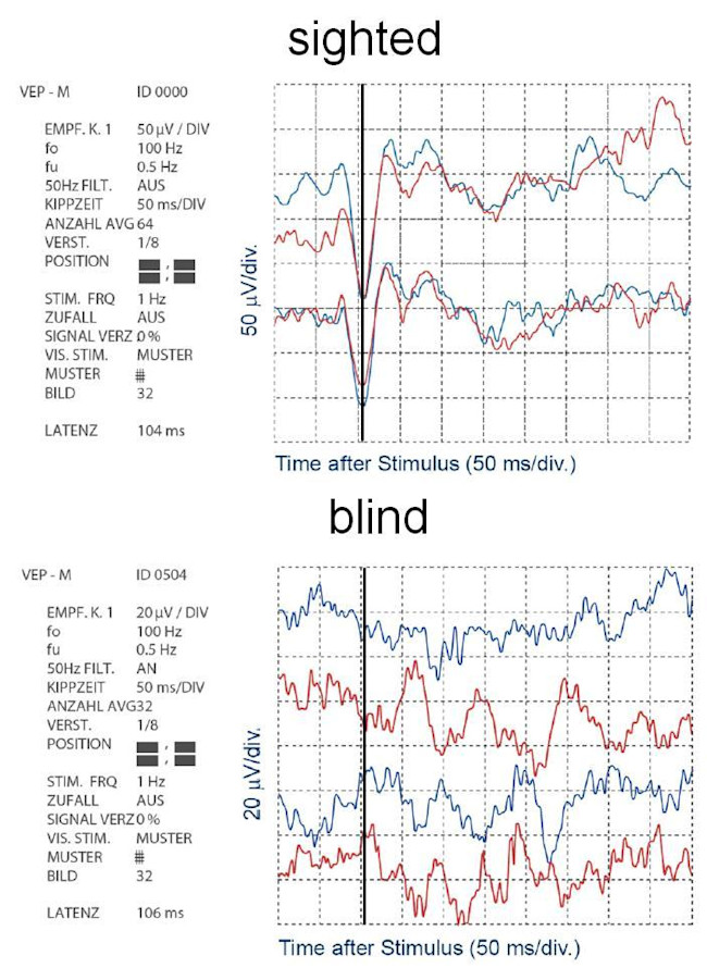 Sighted versus blind VEPs chart
