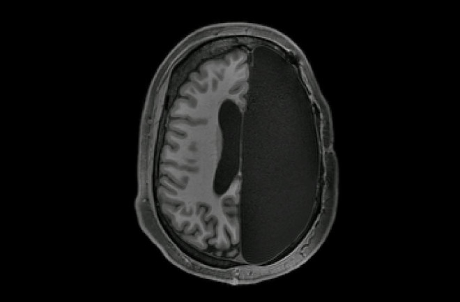 Hemispherectomy-Brain-Scan