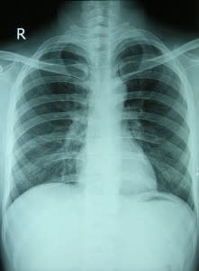 chest_xray_normal-221x300.jpg