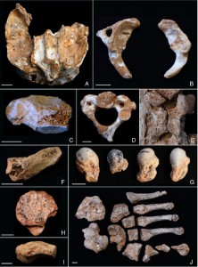Skeletal abnormalities suggesting the El Sidron Neanderthals were inbred (Source: Rios et al 2019 Scientific Reports 9:1697)