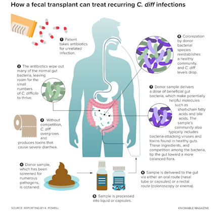 Fecal Transplants: A Curious Cure in Human waste | Discover Magazine