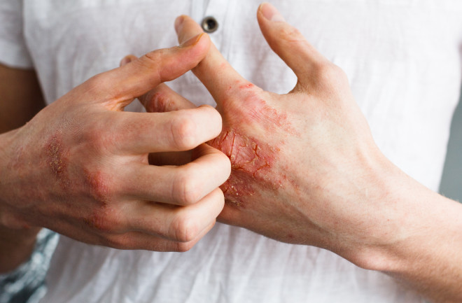 Eczema - Shutterstock