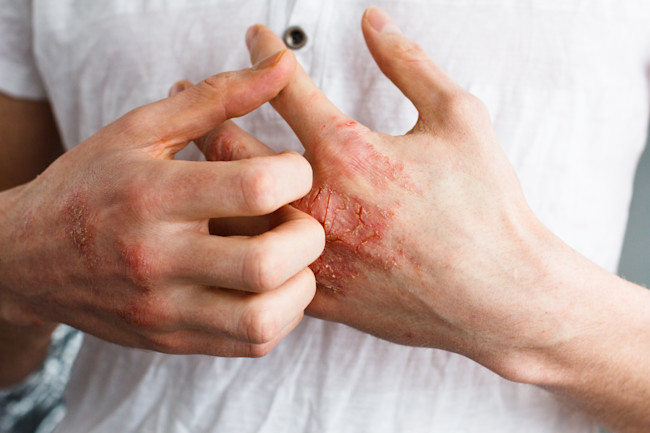 the cure for eczema is likely more than skin deep discover magazine