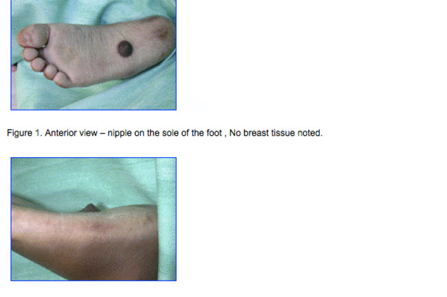 nipple_foot_images.jpg