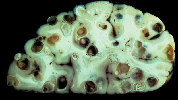Taenia solium, Tapeworms in Brain - Theodore Nash