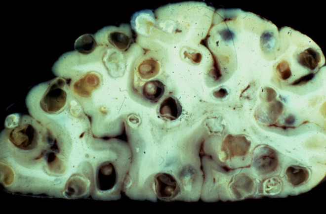 Taenia solium, Tapeworms in Brain - Theodore Nash