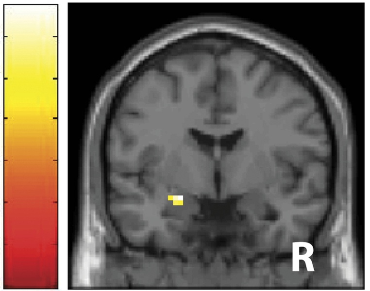 fMRI brain scan