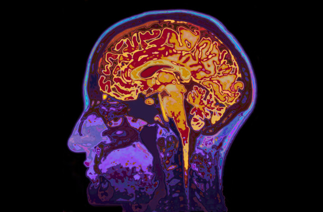 MRI brain scan - shutterstock