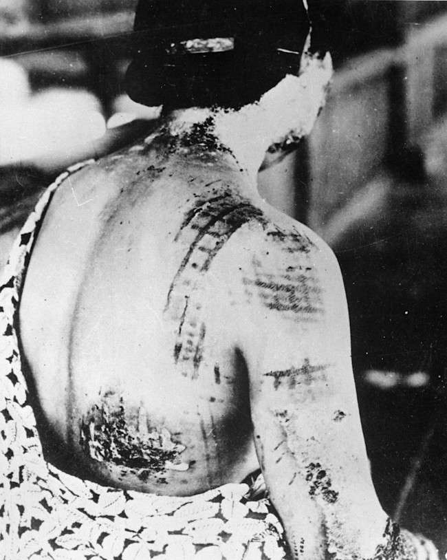 The_patients_skin_is_burned_in_a_pattern_corresponding_to_the_dark_portions_of_a_kimono_-_NARA_-_519686-818x1024.jpg