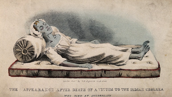A colored lithograph by from 1832 of a deceased cholera victim. Note the blue complexion, sunken face, and emaciated extremities. Source: Wellcome Collection. Click for source.
