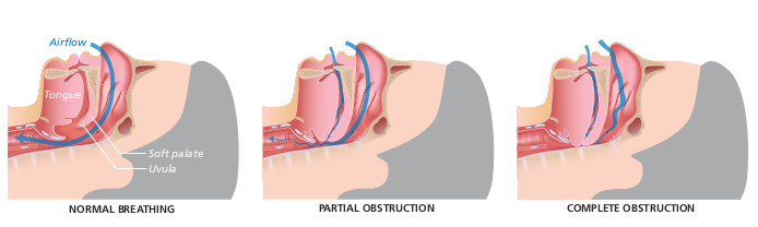 obstructive sleep apnea