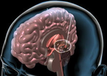 deep-brain-stimulation.jpg