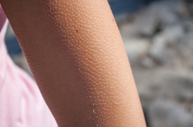 Women's Health on Twitter Skin bumps, Itching skin, Keratosis pilaris treatment