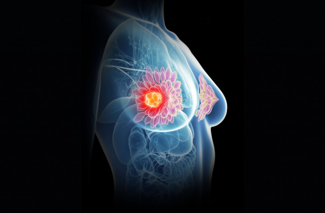 breast cancer risk