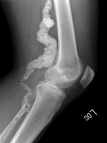bonedisease.jpg