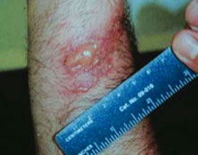 hogweed-burn.jpg