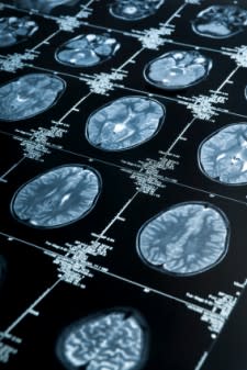 brain-scan-MRI-225x337.jpg