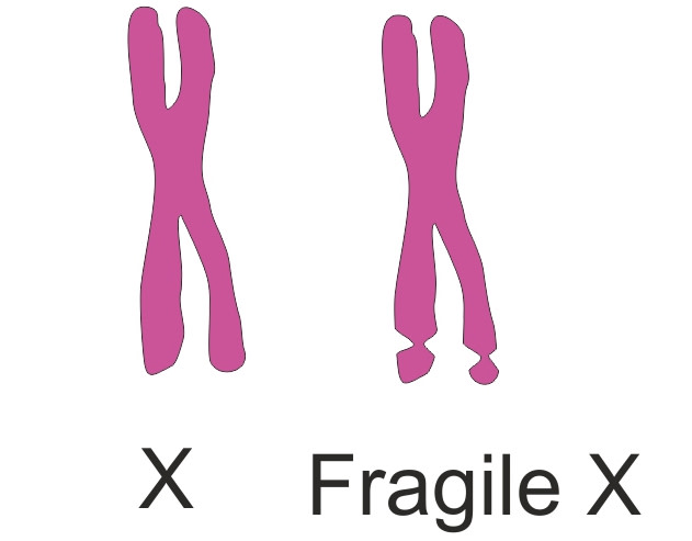 Fragile X - Shutterstock