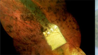 Retinachip.jpg