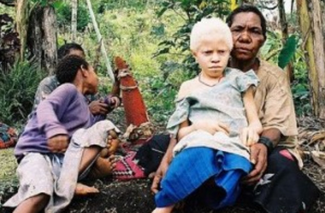Albinistic_girl_papua_new_guinea-300x234.jpg