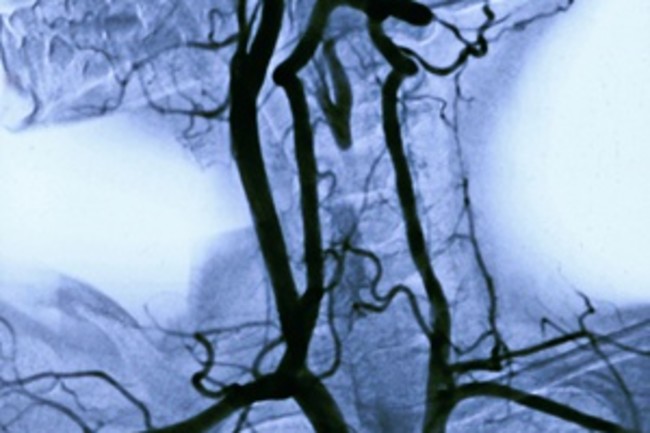 Her Sinusitis Hid a Darker Danger | Discover Magazine Her Sinusitis Hid a Darker Danger | Discover Magazine