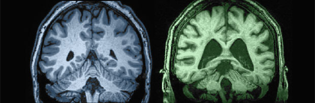 27 year old vs. 87 year old brain ventricles comparison