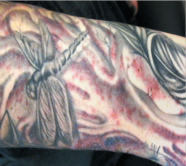 Bad ink: Infection from tattoo shelves P Chapman