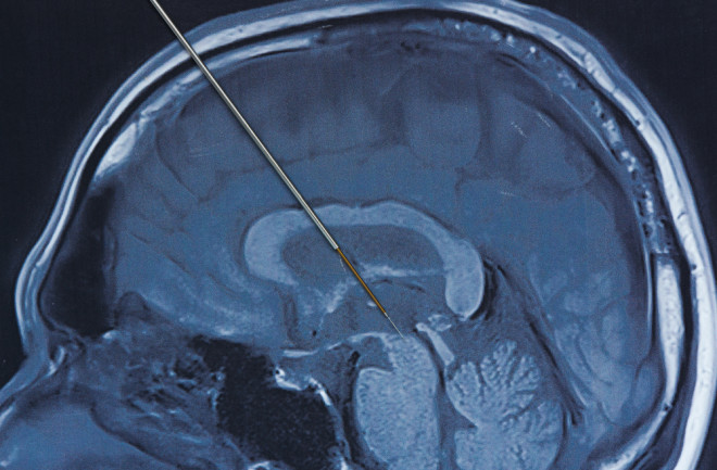 deep brain stimulation concept probe parkinsons disease - shutterstock