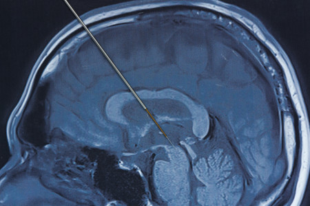 What Is Deep Brain Stimulation, and Why Does It Work for Parkinson's? 
