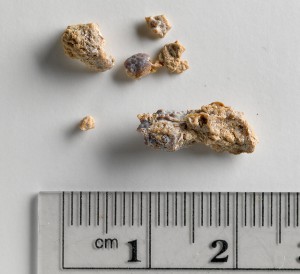 passing a kidney stone
