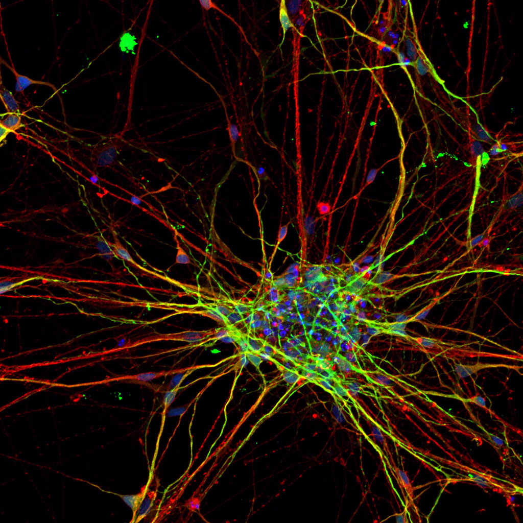 Neurons From People With Autism Grow Differently Scientists Find