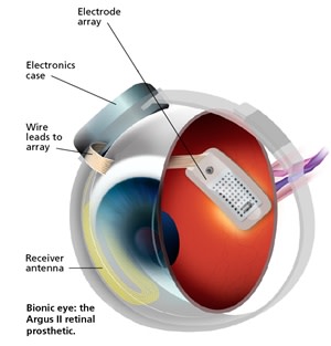bionic-eye