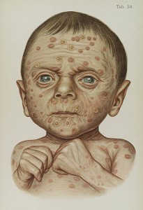 Illustration_of_baby_diseased_with_hereditary_Syphilis_Wellcome_L0038208-205x300.jpg
