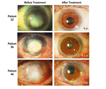 8 Ways to Restore Eyesight to the Blind | Discover Magazine