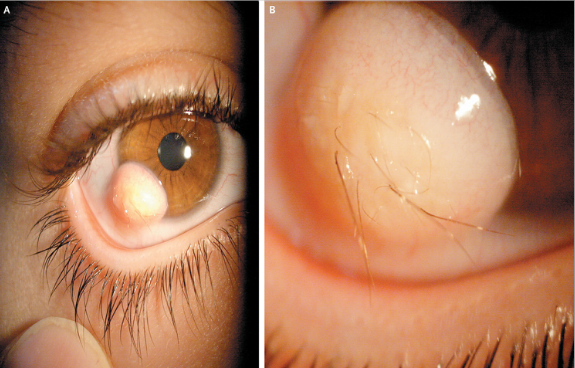 hairy_eyeball_fig.png