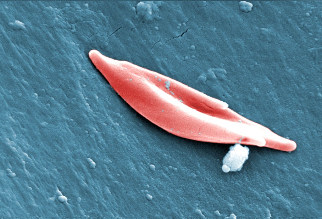 sickle-cell-disease-inherit-two-sickle-cell-genes-s-one-from-each-parent-1024x696.jpg