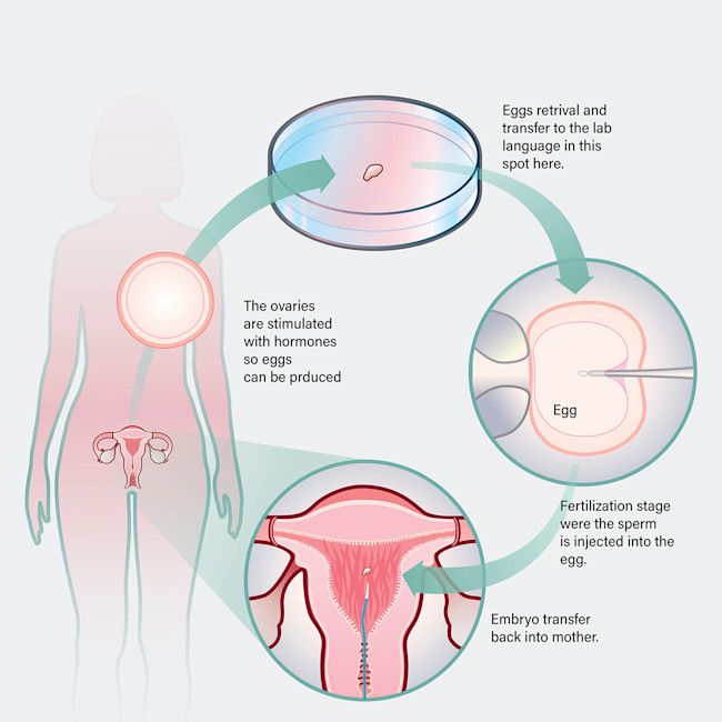 In Vitro Fertilization