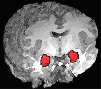 Amygdala_position.jpg