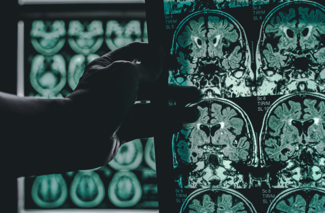Alzheimer’s Brain Scans - Shutterstock