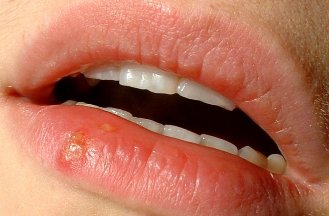The Upside Of Herpes When One Infection Protects Against Another Discover Magazine The Upside Of Herpes When One Infection Protects Against Another Discover Magazine