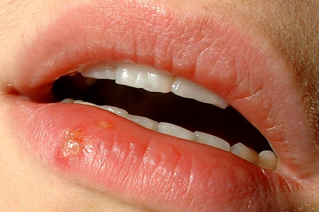 The Upside of Herpes — When One Infection Protects Against Another | Discover Magazine The Upside of Herpes — When One Infection Protects Against Another | Discover Magazine